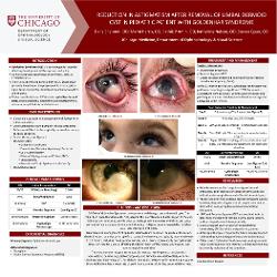 Reduction in Astigmatism After Removal of Corneal Dermoid Cyst in Pediatric Patient with Goldenhar Syndrome