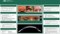 Fila-ment To Be: Atypical Etiology and Management of Filamentary Keratitis