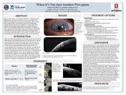 When a Pterygium is not a Pterygium: A case of Ocular Surface Squamous Neoplasia treatment in a complex patient