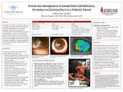 Scleral Lens Management of Limbal Stem Cell Deficiency Secondary to Chemical Burn in a Pediatric Patient