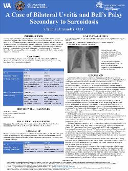 A Case of Bilateral Uveitis and Bell’s Palsy Secondary to Sarcoidosis