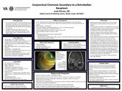 Conjunctival Chemosis Secondary to a Retrobulbar Neoplasm