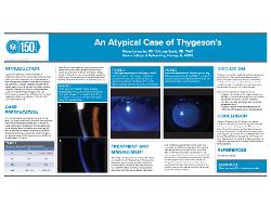 An Atypical Case of Thygeson's