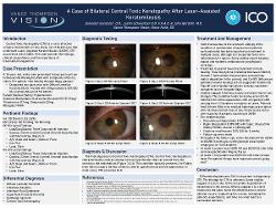 A Case of Bilateral Central Toxic Keratopathy After Laser-Assisted Keratomileusis (LASIK)
