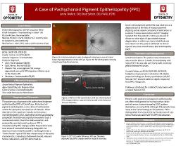 A Case of Pachychoroid Pigment Epitheliopathy