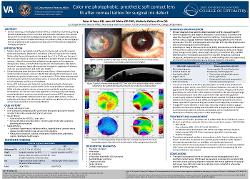 Color me photophobic: prosthetic soft contact lens fit after corneal tattoo for surgical iris defect