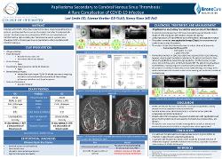 Papilledema Secondary to Cerebral Venous Sinus Thrombosis: A Rare Complication of COVID-19 Infection