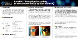 Late IOL Dislocation Secondary to Pseudoexfoliation Syndrome (PEX)