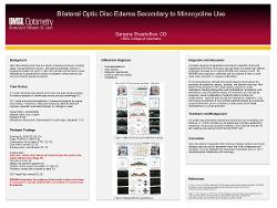 Bilateral Disc Edema Secondary to Minocycline Use