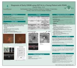 Diagnosis of Early Choroidal Neovascular Membrane using OCT Angiography in a Young Female Patient with Presumed Ocular Histoplasmosis Syndrome