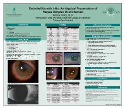Endotheliitis with Iritis: An Atypical Presentation of Herpes Simplex Viral Infection