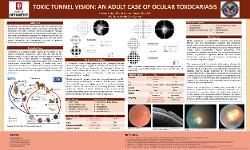 Toxic Tunnel Vision: An Adult Case of Ocular Toxocariasis