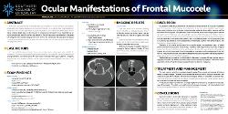 Ocular Manifestations of Frontal Sinus Mucocele