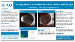 Terson Syndrome: A Rare Presentation of Vitreous Hemorrhage