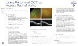 Using Peripheral OCT to Assess Retinal Holes