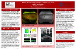 Retinal Telangiectasia with Vitritis: Infectious or Not?