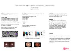Pseudo-glaucomatous cupping in a pediatric patient with periventricular leukomalacia
