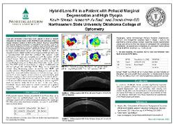Hybrid Lens Fit in a Patient with Pellucid Marginal Degeneration and High Myopia