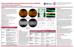 Diagnosing Multiple Evanescent White Dot Syndrome (MEWDS): The Common Cold of the Retina