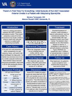 There’s A First Time for Everything: Initial Episode of HLA-B27 Associated Anterior Uveitis in a Patient with Ankylosing Spondylitis