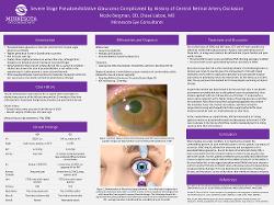 Severe Stage Pseudoexfoliative Glaucoma Complicated by History of Central Retinal Artery Occlusion