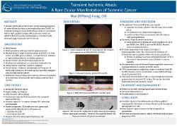 Transient Ischemic Attack: A Rare Ocular Manifestation of Systemic Cancer