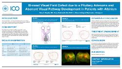Bi-nasal Visual Field Defect Likely due to a Pituitary Adenoma and Aberrant Visual Pathway Development in Patients with Albinism