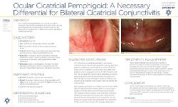 Ocular Cicatricial Pemphigoid: a Necessary Differential for Bilateral Cicatricial Conjunctivitis