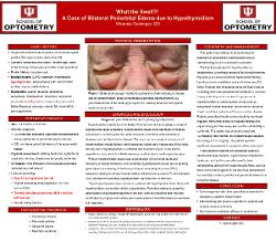 What the Swell?! A Case of Bilateral Periorbital Edema due to Hypothyroidism