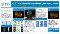 A Case of Recurrent Panuveitis Secondary to Behcet's Disease