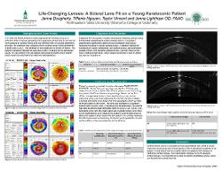 Life-Changing Lenses: A Scleral Lens Fit on a Young Keratoconic Patient