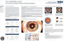 Is It Just Bad Luck?: An Atypical Case of Zonular Insufficiency