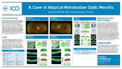 A Case of Atypical Retrobulbar Optic Neuritis