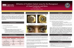 Utilization of Prosthetic Contact Lenses for the Management of Visual Confusion and Glare