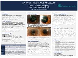A Case of Bilateral Anterior Capsular Phimosis After Cataract Surgery