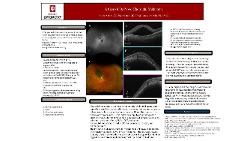 A Case of De Novo Choroidal Melanoma
