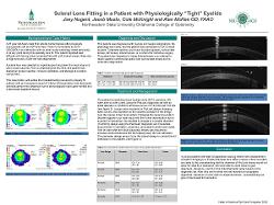 Scleral Lens Fitting in a Patient with Physiologically “Tight” Eyelids