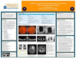 Papilledema with Overlying Vitritis Secondary to Metastatic Lesions from Lung Adenocarcinoma