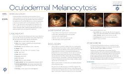Oculodermal melanocytosis