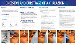 Incision and Curettage of a Chalazion
