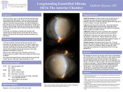 Qadium Qayum, OD Longstanding Emulsified Silicone Oil in the Anterior Chamber