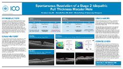 Spontaneous Resolution of a Stage 2 Idiopathic Full Thickness Macular Hole