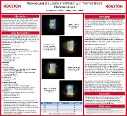 Brandon Le, OD Neovascular Glaucoma in a Diabetic Patient with ‘Normal’ Blood Glucose Levels