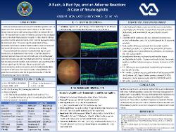Alicia Brown, OD A Rash, A Red Eye, and an Adverse Reaction: A Case of Neurosyphilis