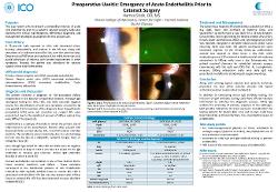 Hamza Shah, OD,MS Preoperative Inflammation: Urgency of Acute Endotheliitis Prior to Cataract Surgery