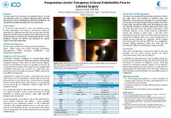 Preoperative Inflammation: Urgency of Acute Endotheliitis Prior to Cataract Surgery