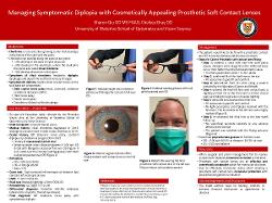 Sharon Qiu, OD,MS Managing Symptomatic Diplopia with Cosmetically Appealing Prosthetic Soft Contact Lenses