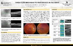 Fovea Plana Secondary to Prematurity in Twin Boys