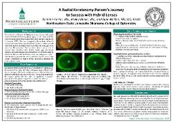 A Radial Keratotomy Patient's Journey to Success with Hybrid Lenses