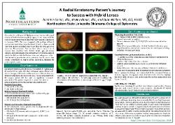 Jazmine Casias, BS A Radial Keratotomy Patient's Journey to Success with Hybrid Lenses